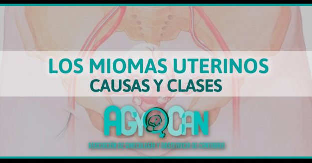 MIOMAS UTERINOS CLASES Y CAUSAS MIOMAS UTERINOS CLASES Y CAUSAS
